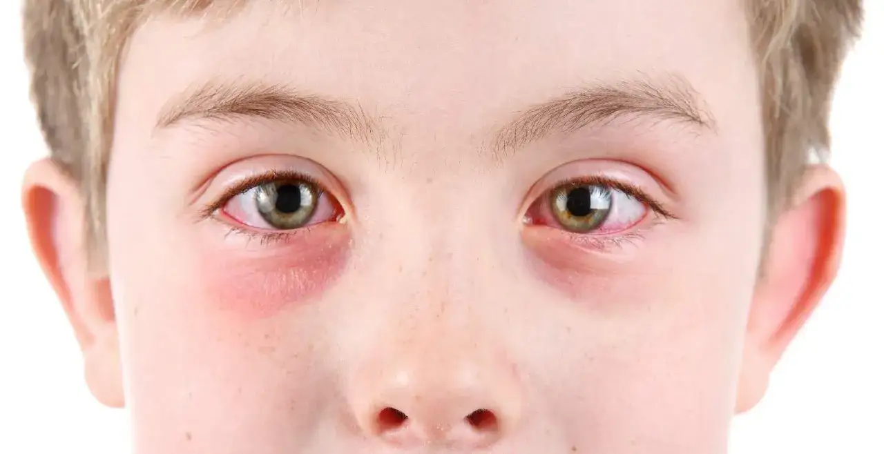 Ojos rojos e irritados de un ni&ntilde;o, mostrando la diferencia entre conjuntivitis y mocos en los ojos.