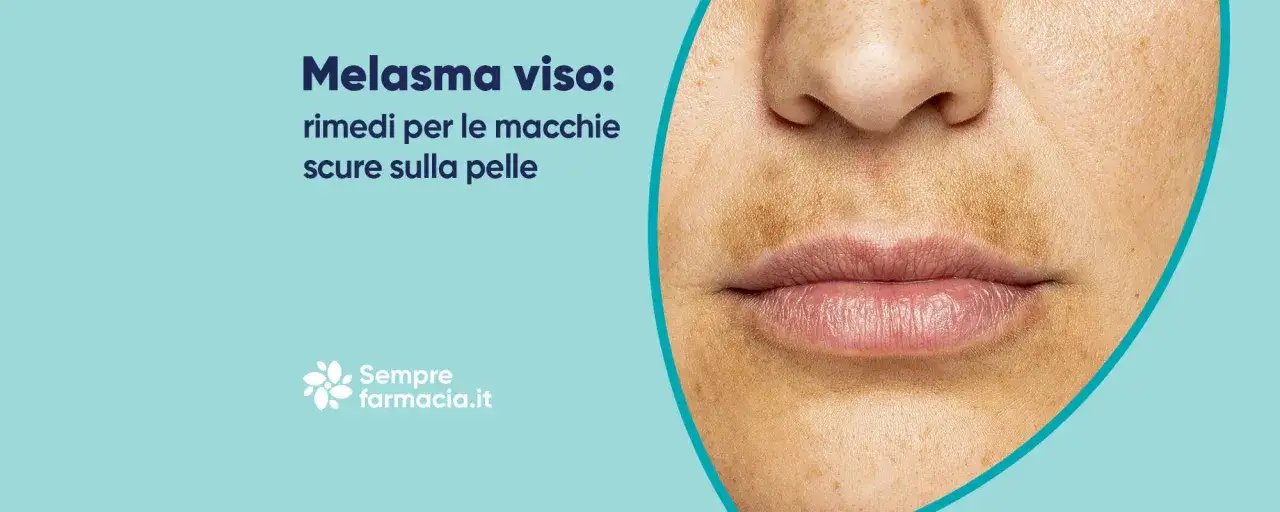 Primo piano del viso con macchie scure, in particolare un'area che ricorda il melasma baffetti. Rimedi per le macchie scure sulla pelle.