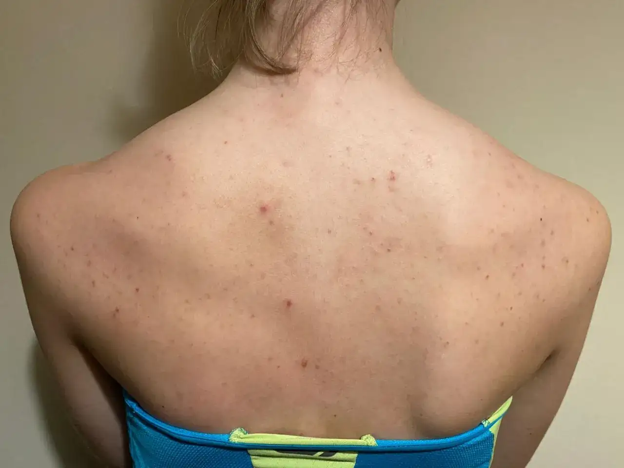 Espalda con brotes rojizos y peque&ntilde;os granos, indicativos de posible acne fungico.