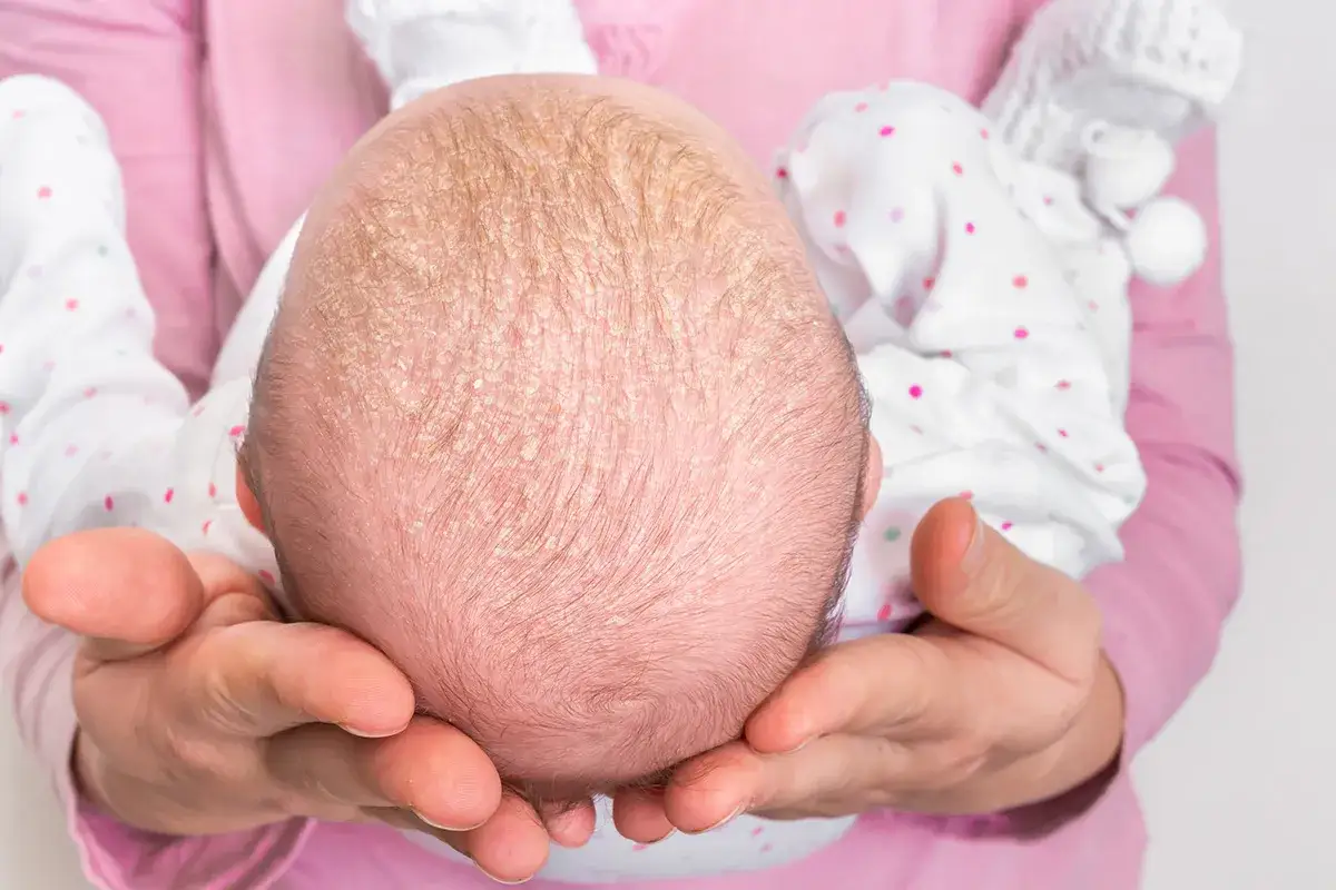 Hände halten den Kopf eines Babys mit trockener Kopfhaut und Schuppen.