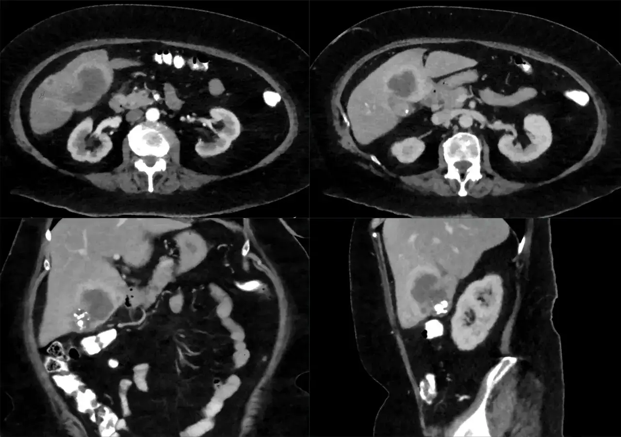 Scansione TC addominale che mostra lesioni multiple nel fegato, suggestive di metastasi epatiche.