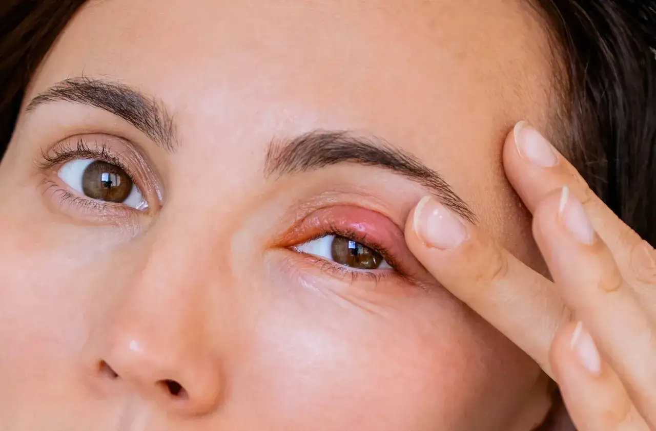 Gros plan sur un œil présentant un orgelet rouge et gonflé, suggérant un traitement antibiotique nécessaire pour soulager l'inflammation.