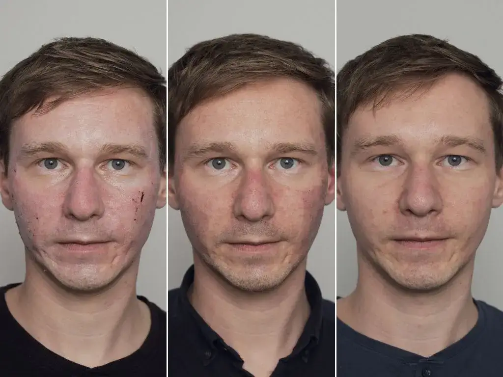 Zdjęcie Kiedy widać efekty po laserze frakcyjnym? Poznaj pełny czas poprawy
