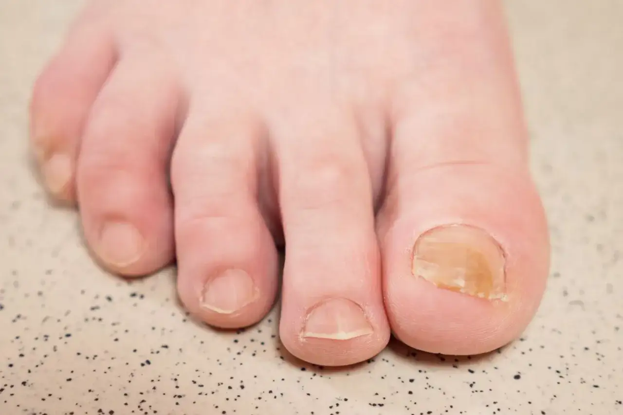 Primer plano de unos pies con u&ntilde;as amarillas, mostrando el dedo gordo con una u&ntilde;a afectada.