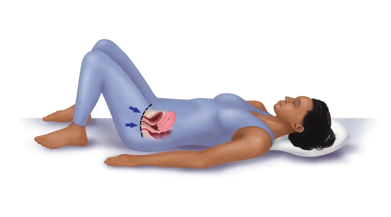 Illustration d'une femme allongée, montrant l'anatomie pelvienne et des flèches indiquant le renforcement des muscles du plancher pelvien, essentiel pour les exercices de **boules de Kegel**.