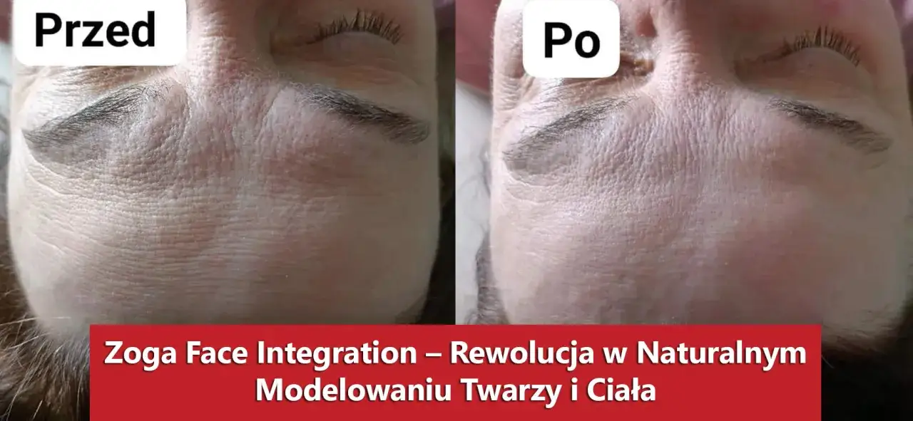 Przed i po zabiegu Zoga Face Integration. Widoczne wygładzenie zmarszczek na czole i wokół oczu.