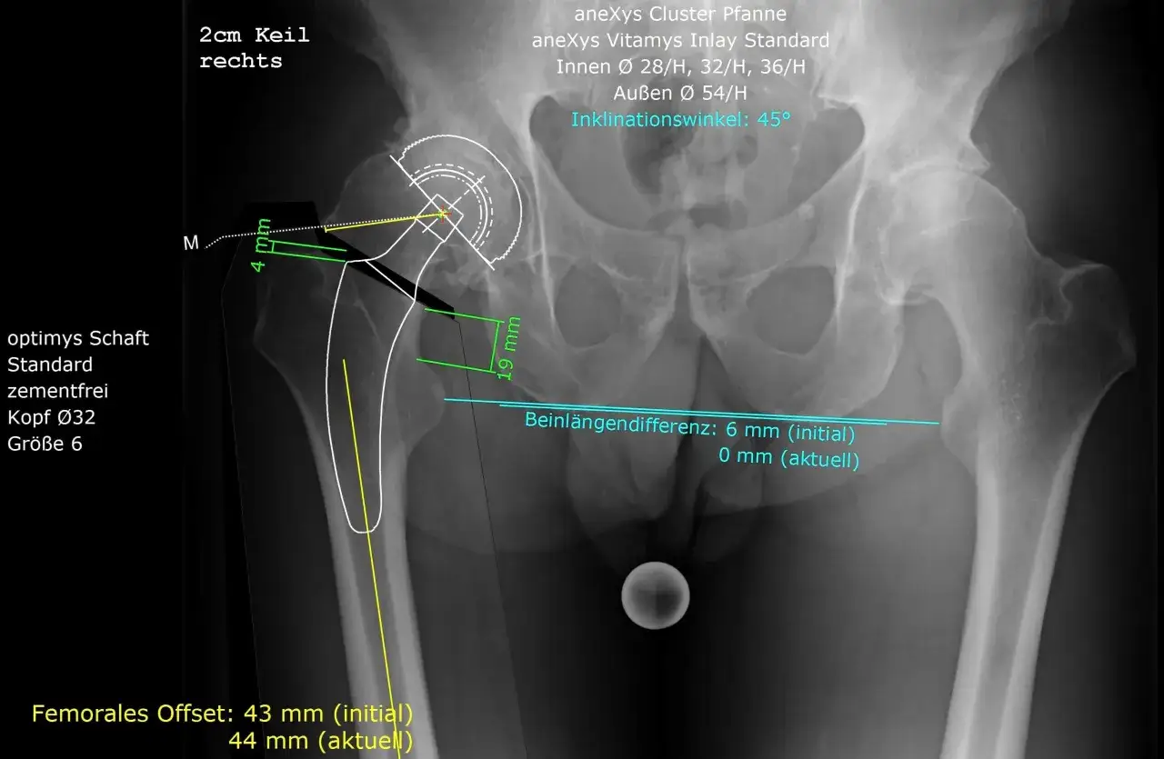 R&ouml;ntgenbild des rechten H&uuml;ftgelenks mit Markierungen zur Beurteilung der coxarthrose stadien und Implantatposition.