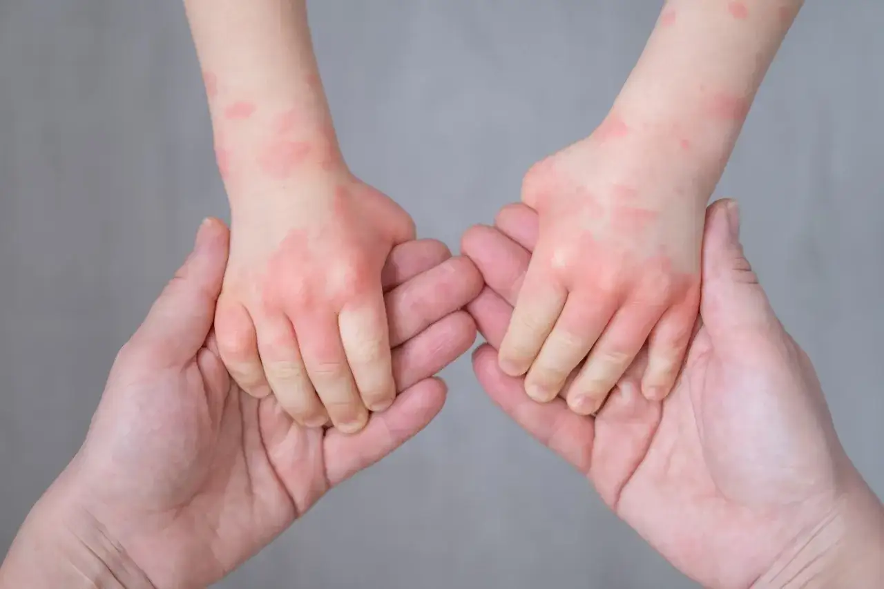 Alergia pokarmowa u dzieci objawy sk&oacute;rne