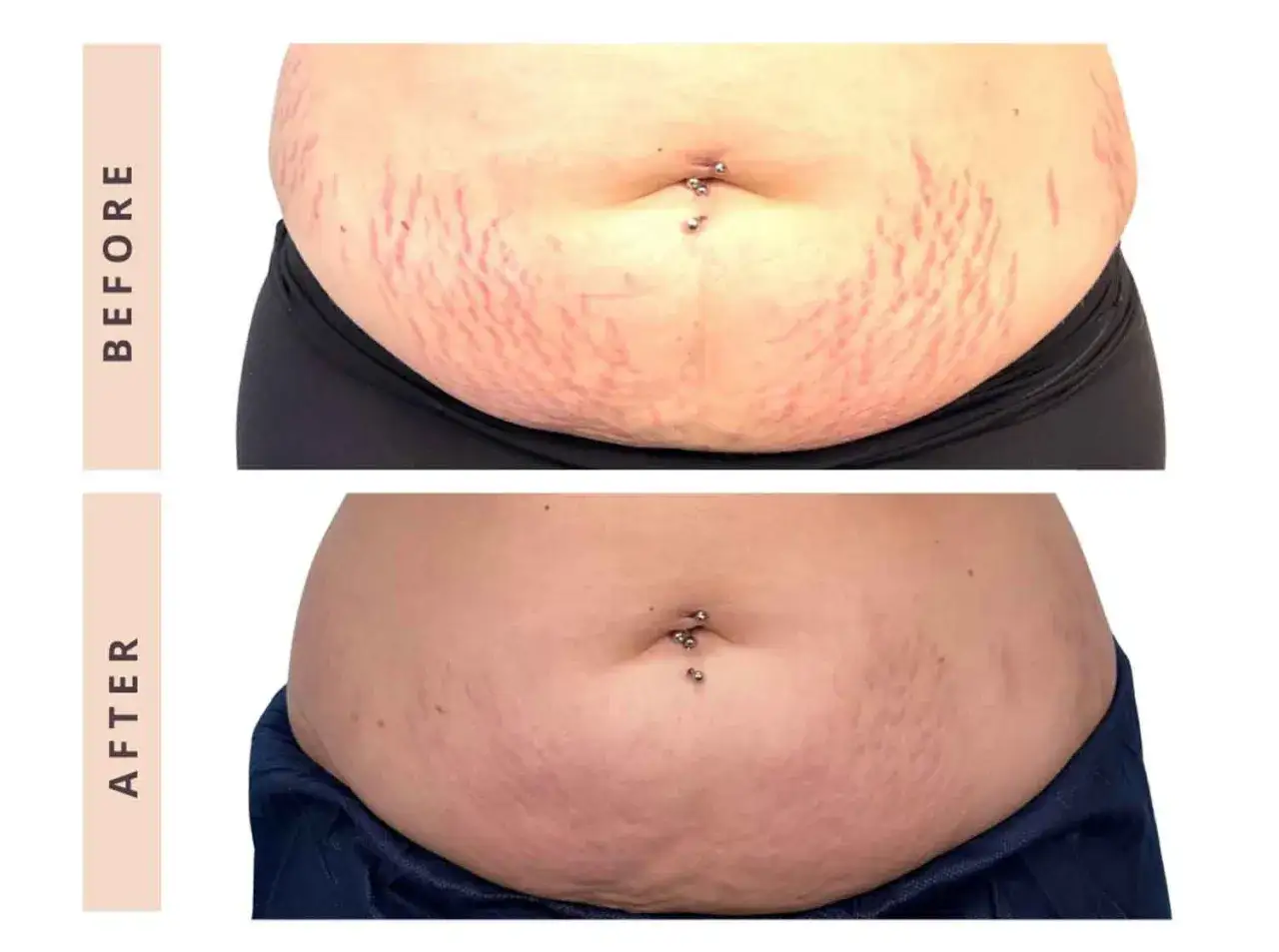 Abdomen con estr&iacute;as moradas antes y despu&eacute;s de un tratamiento.