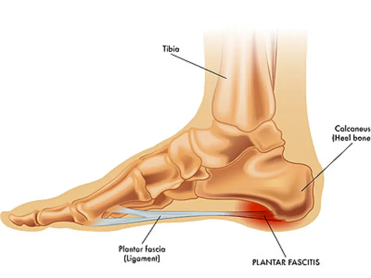 Anatomische Darstellung des Fu&szlig;es mit hervorgehobener Plantarfaszie und Fersenknochen. Die rote Markierung zeigt, wo die Plantarfasziitis immer schlimmer wird.