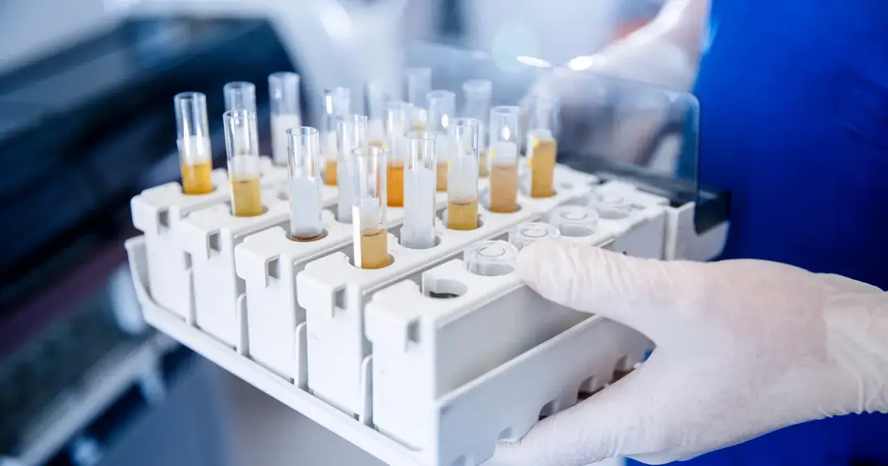 Rękawiczka laboratoryjna trzyma stojak z probówkami z żółtym płynem, potencjalnie badając bakterie w moczu.