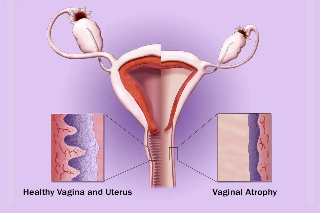 Illustration visar livmoder och &auml;ggstockar, med n&auml;rbilder p&aring; frisk och atrofisk vagina. Atrofi kan orsaka ont vid samlag klimakteriet.