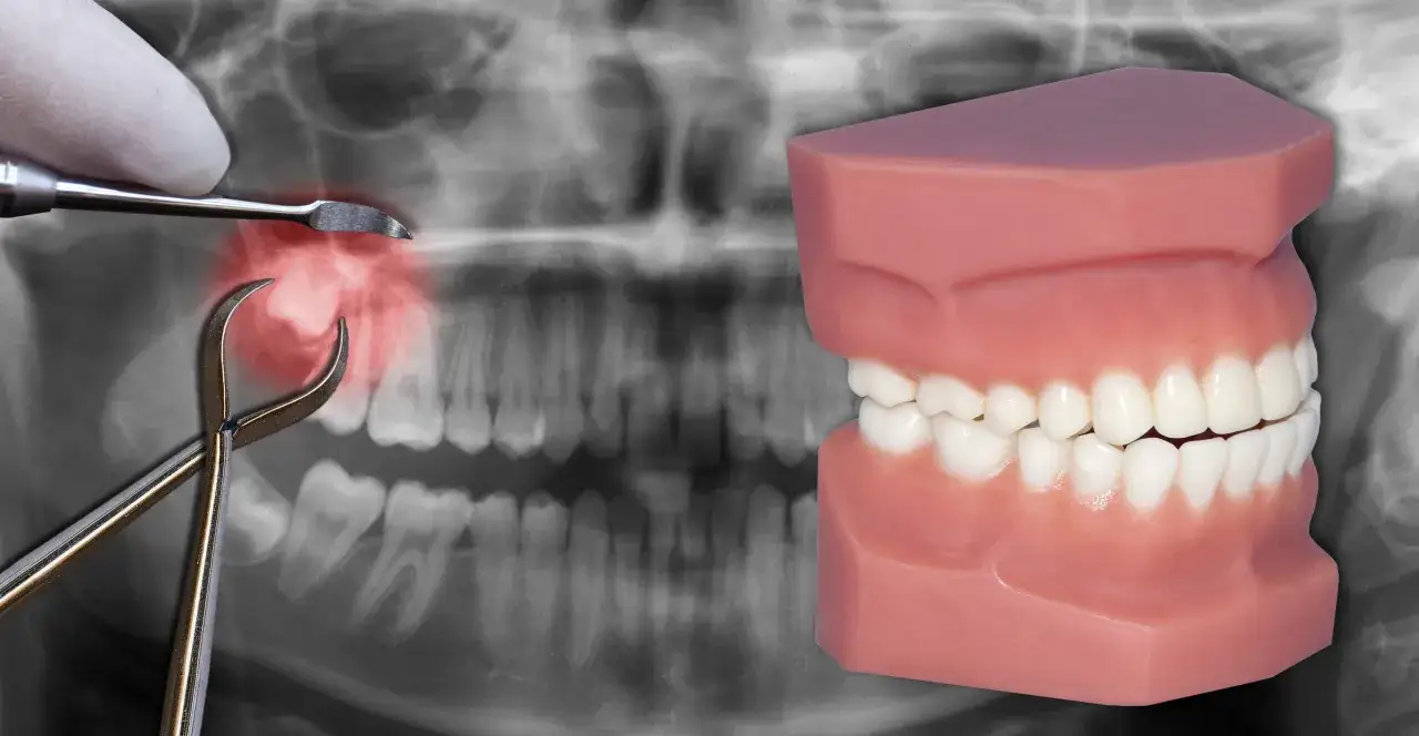 Rentgen szczęki z narzędziami dentystycznymi i modelem zębów. Widać, że ósemka ząb jest zaznaczona na czerwono, sugerując problem.