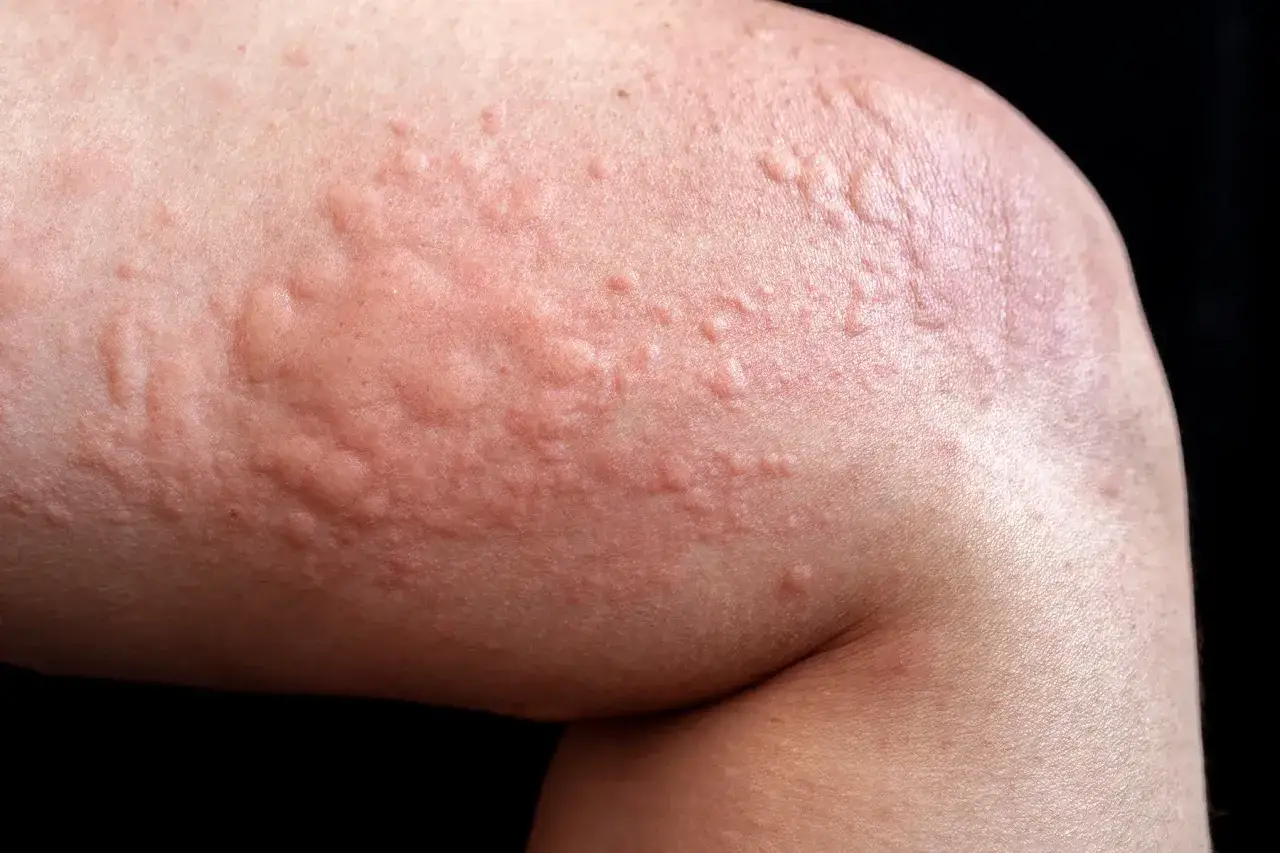 N&auml;rbild p&aring; en arm med r&ouml;da, upph&ouml;jda allergiska utslag som kliar.