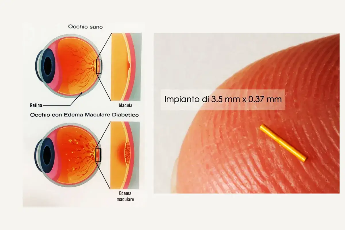 Illustrazione occhio sano vs occhio con edema maculare diabetico, con ingrandimento macula. Accanto, impianto oculare. Le cause dell'edema maculare cistoide sono molteplici.