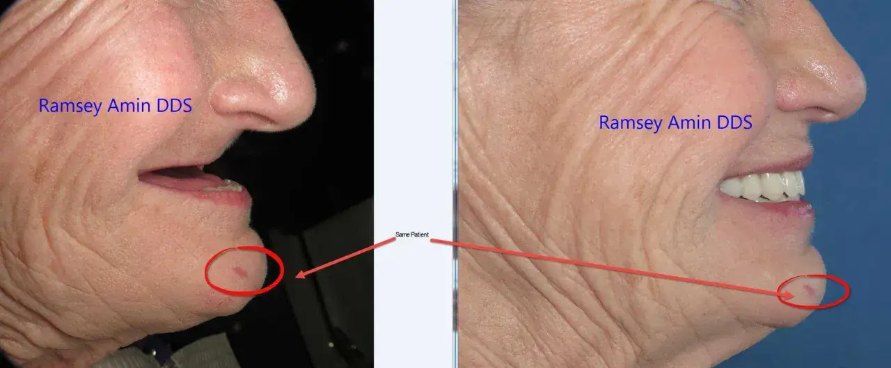 Antes y después: los implantes dentales cambia la cara, devolviendo una sonrisa y mejorando la estructura facial.