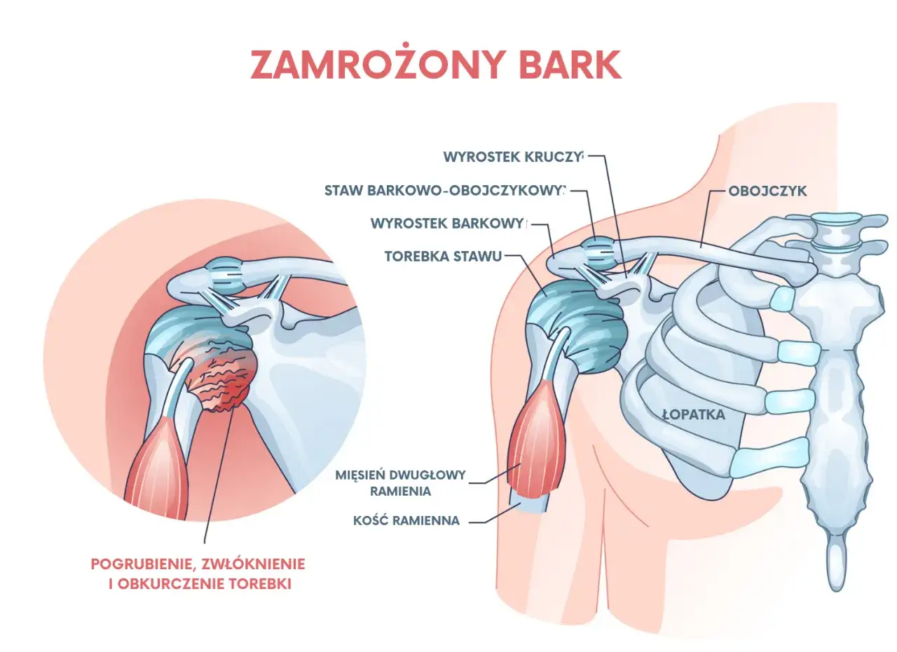 Ilustracja pokazuje zamrożony bark: pogrubienie, zwłóknienie i obkurczenie torebki stawu ramiennego, co jest kluczowym objawem.