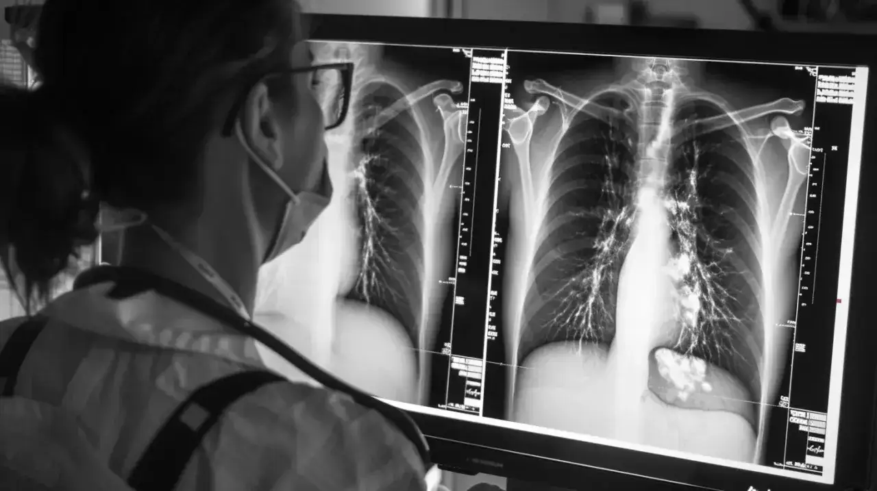 Lekarz analizuje RTG klatki piersiowej, szukając oznak **wody w płucach**. Widoczne są nieprawidłowości w obrazie płuc.