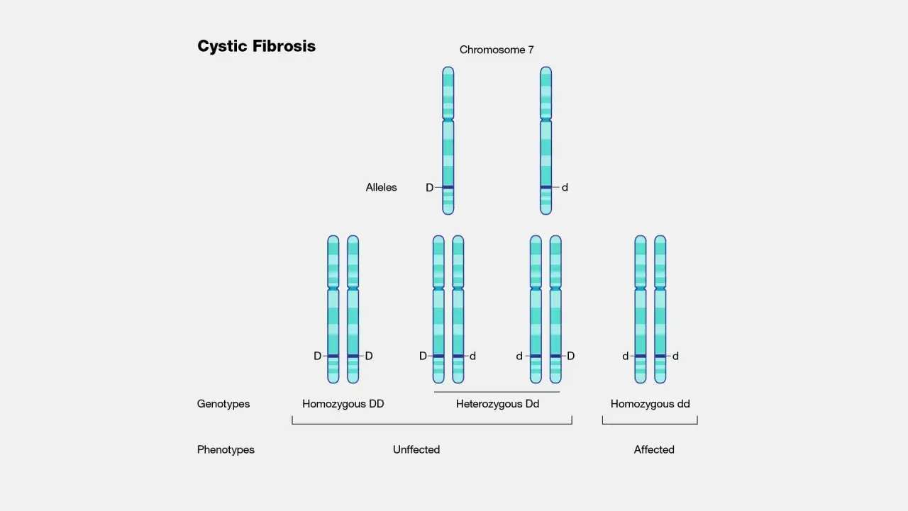 Spiegazione genetica della fibrosi cistica: cromosomi, alleli D/d, genotipi (DD, Dd, dd) e fenotipi (sano, portatore, affetto).