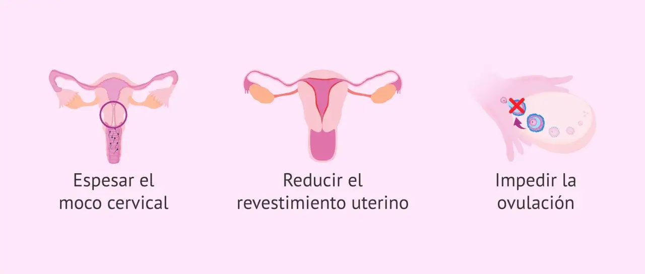 Ilustraci&oacute;n de los tipos de DIU hormonales: espesan el moco cervical, reducen el revestimiento uterino e impiden la ovulaci&oacute;n.