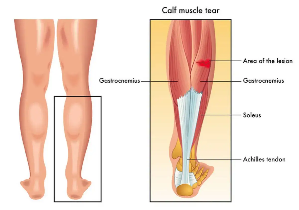 Illustration visar en vadmuskel med en bristning. En bild av benet visar var skadan sitter. Gubbvad behandling kan hjälpa till att läka.