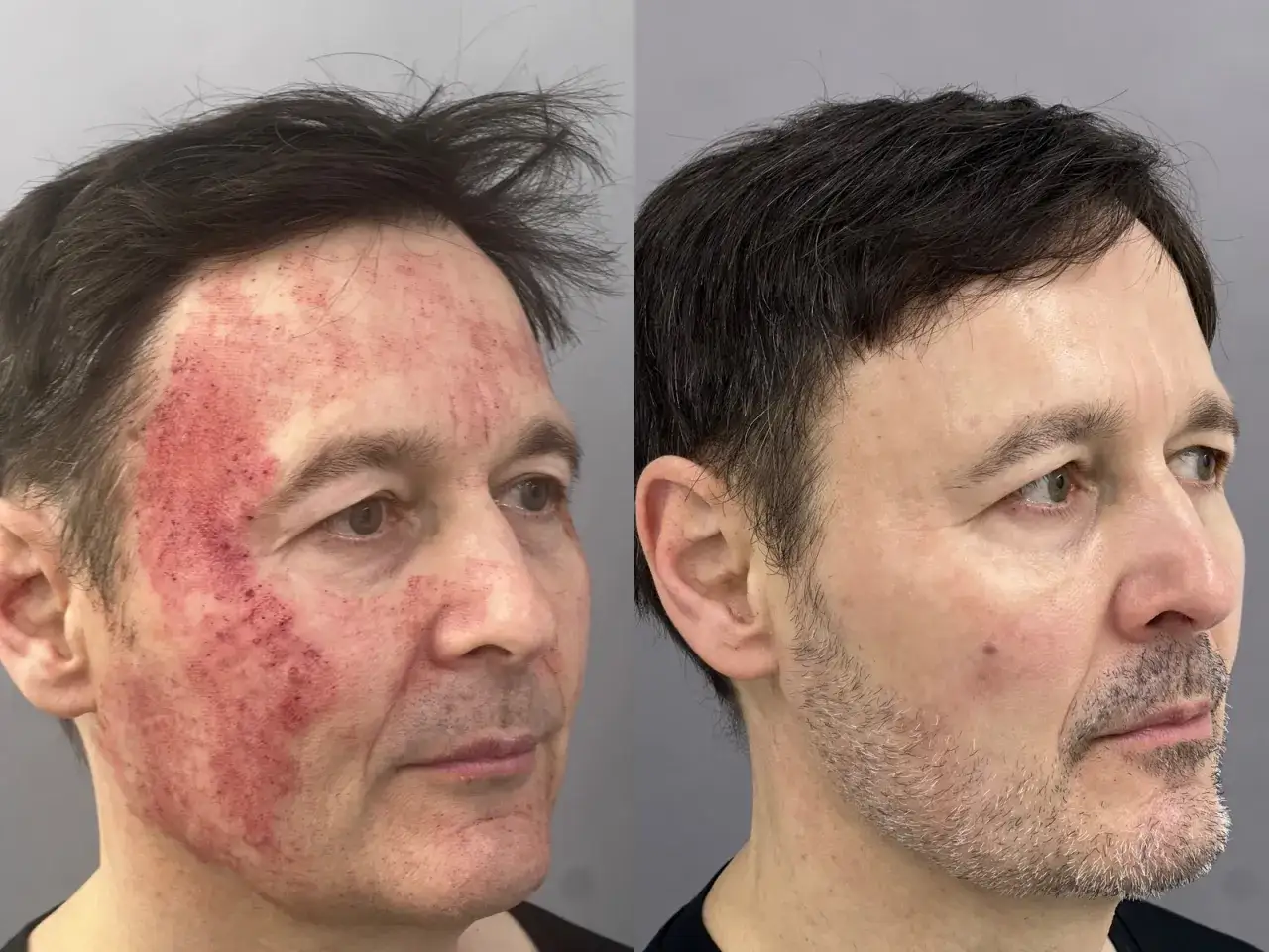 Przed i po laserze frakcyjnym. Skóra zaczerwieniona, potem wygojona. Pytanie: jaki krem po laserze frakcyjnym?