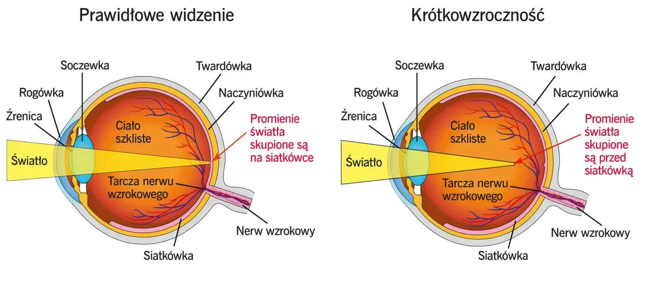Por&oacute;wnanie oka z wadą wzroku minus (kr&oacute;tkowzroczność) i prawidłowego widzenia. Promienie światła skupiają się przed siatk&oacute;wką.