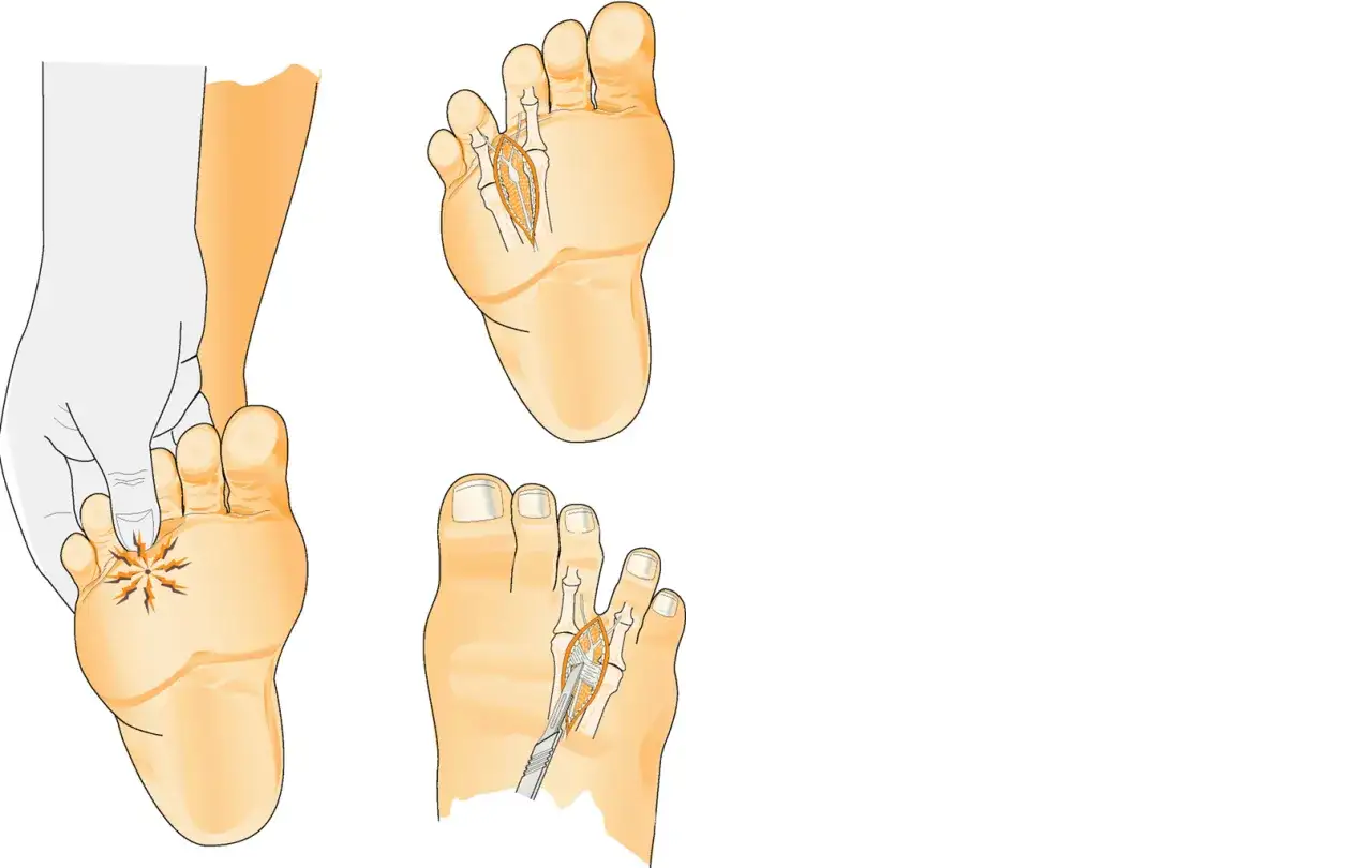 Illustration visar en fot med smärta i framfoten, möjligen relaterat till plantar fasciit. En hand trycker på ett smärtande område.