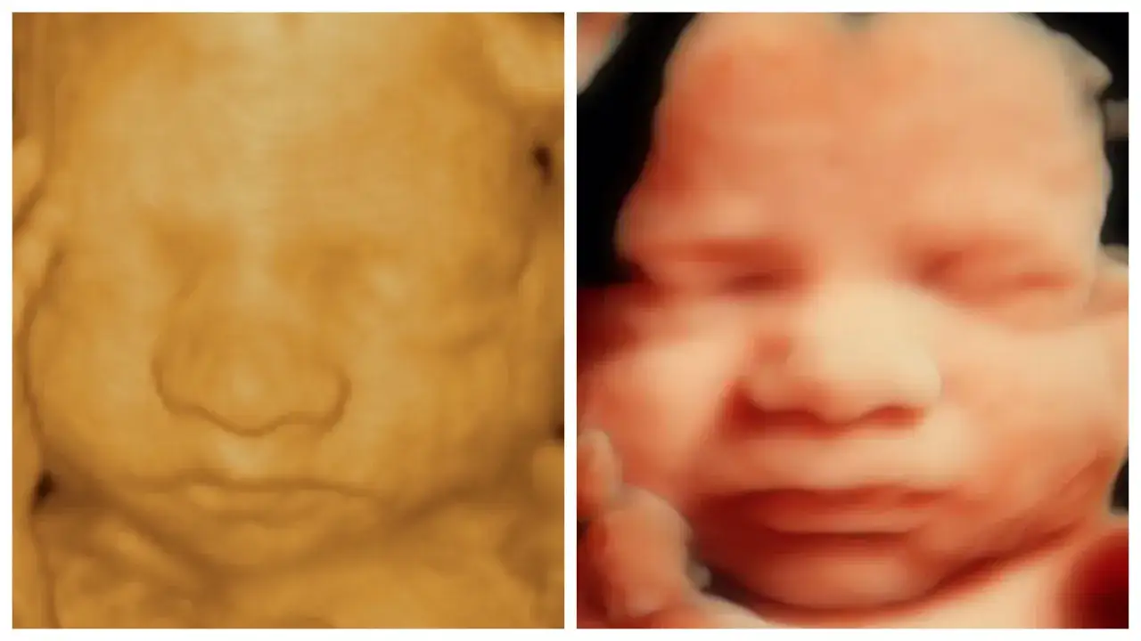 Zwei 3D-Ultraschallbilder zeigen Gesichter von Babys. Links ein Gesicht in Gelb-Orange, rechts ein Gesicht in Rosa-Orange. Beide sind ca. 21 ssw.