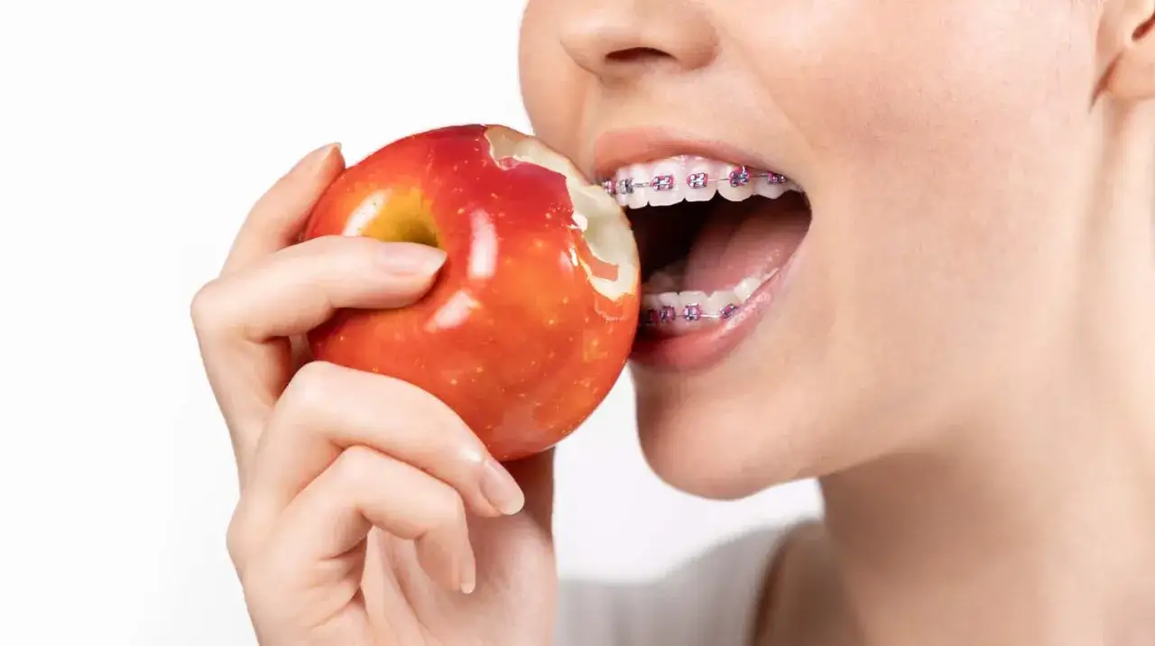 Mentre si morde una mela rossa, si vedono i denti con l'apparecchio. Un esempio di cosa mangiare con l'apparecchio, con cautela!