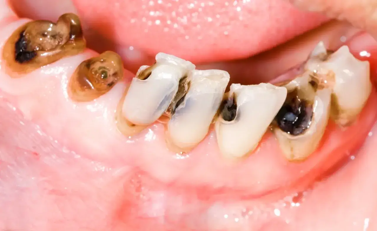 Denti con evidenti carie, alcuni spezzati e scuri, che necessitano di cure urgenti.