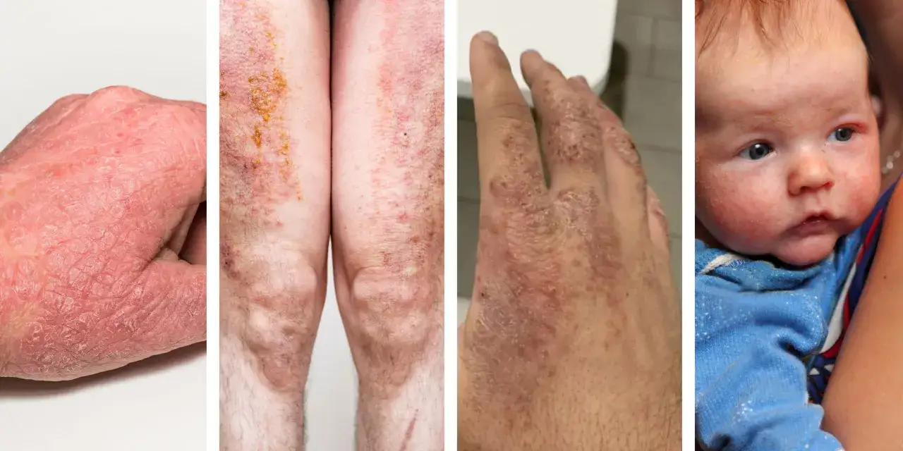 Pelle secca e arrossata su mani, gambe e viso di neonato, sintomi di eczema bambini.