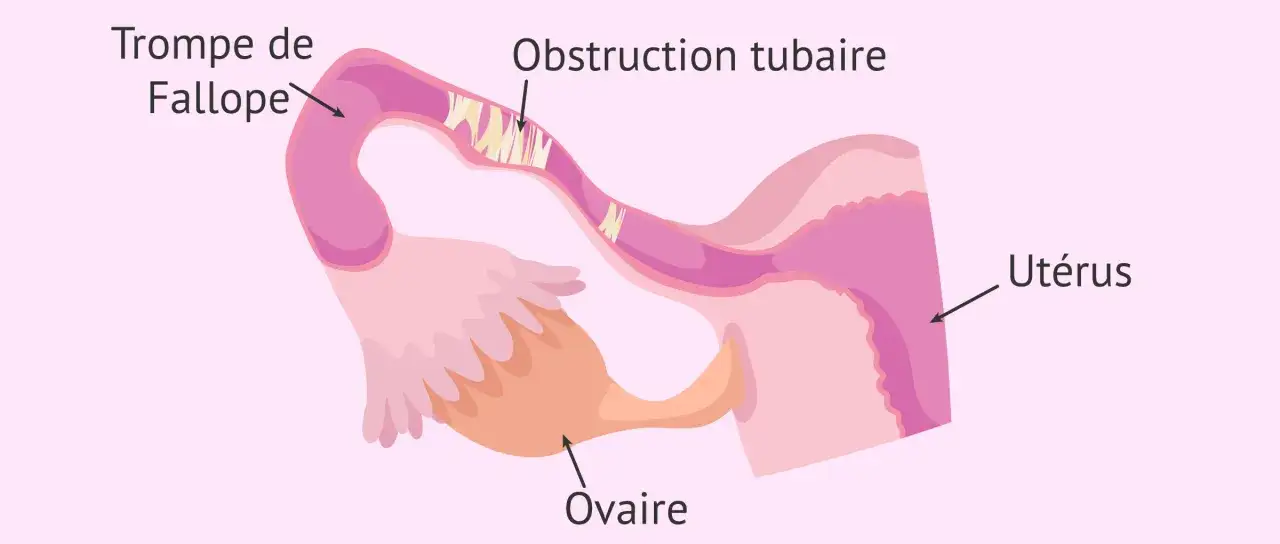 Illustration d'une trompe de Fallope obstruée, montrant une
