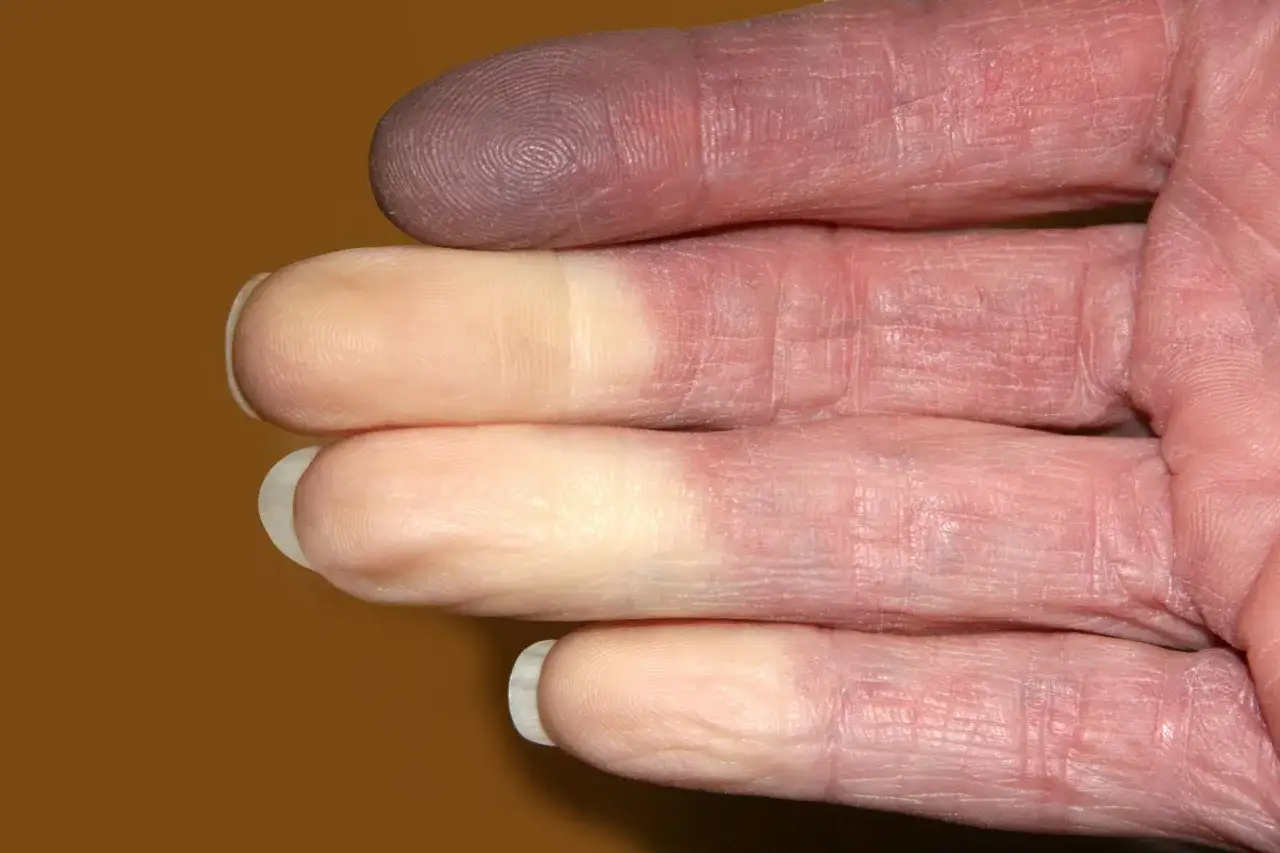 Syndrom Raynauda palce zmieniają kolor