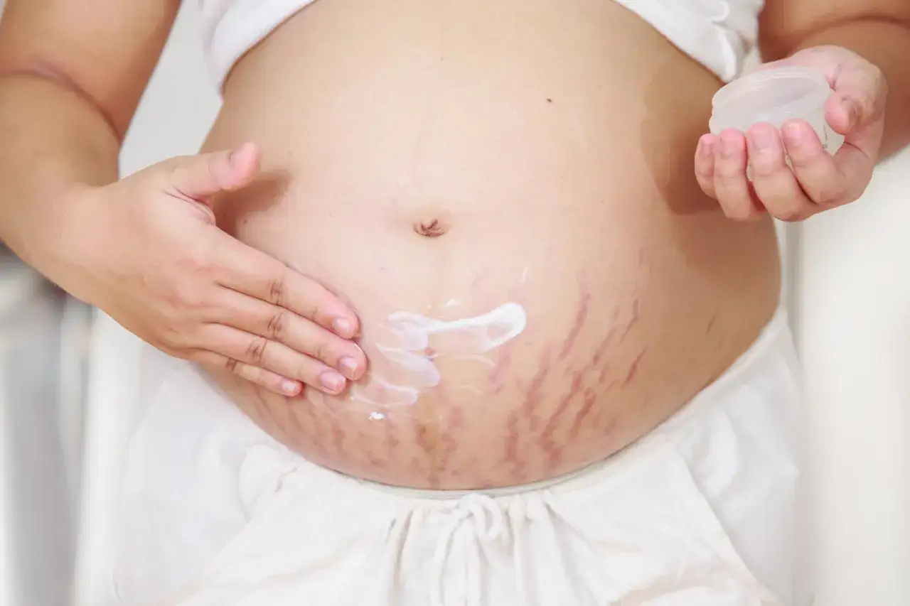 Mano applica crema su pancia con inizio smagliature gravidanza.