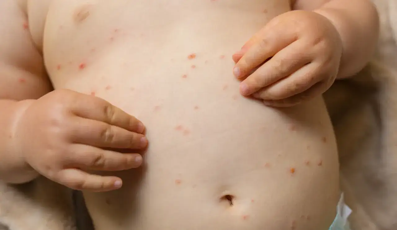Torse d'un bébé couvert de boutons rouges, signe de varicelle. Le traitement de chaque bouton est essentiel pour le confort de l'enfant.