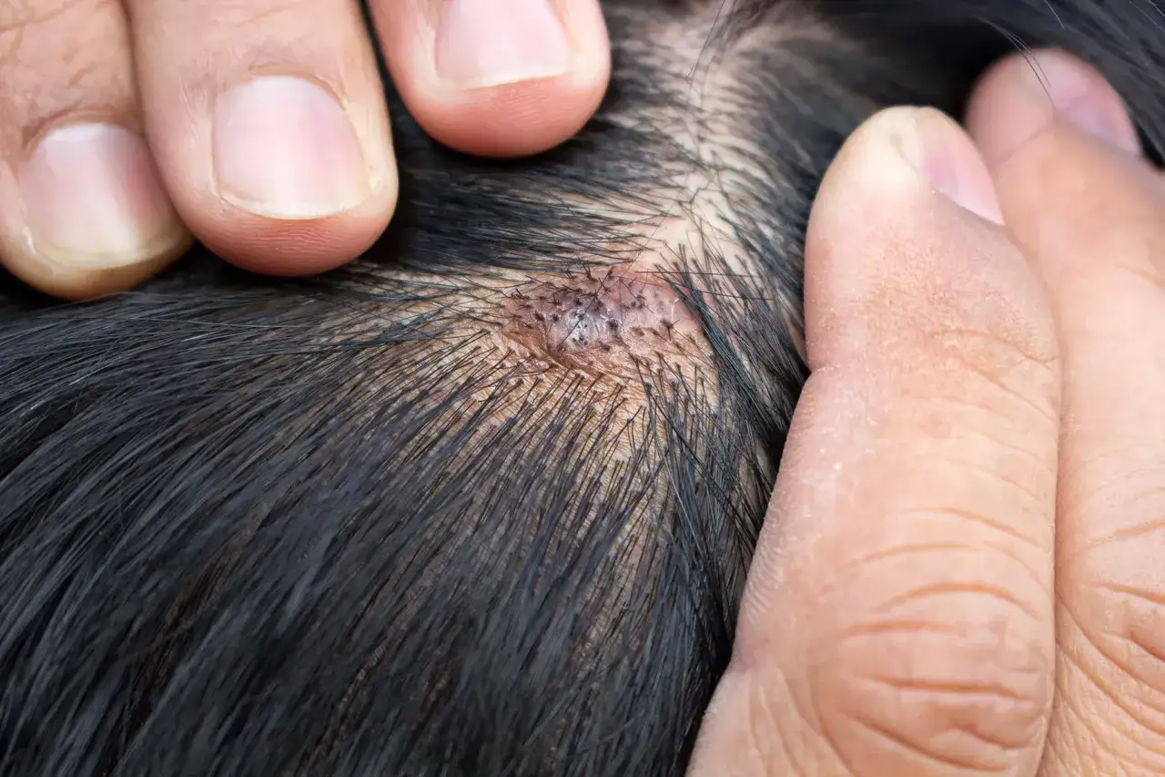 Dłonie rozchylają ciemne włosy, ukazując zaczerwienioną, łuszczącą się skórę głowy z widocznymi strupkami. To objaw silnego swędzenia skóry głowy.