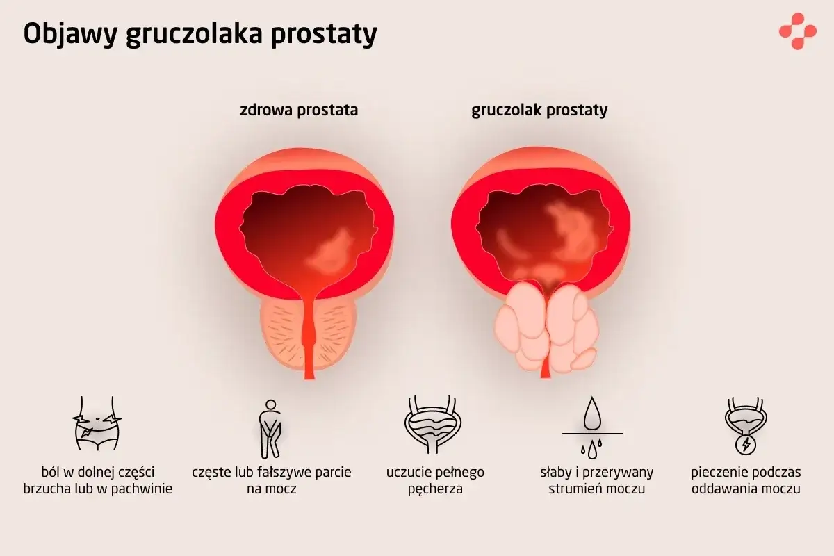 Porównanie zdrowej prostaty i gruczolaka prostaty. Obrazek pokazuje objawy przerostu prostaty, takie jak ból, częste parcie na mocz i słaby strumień.