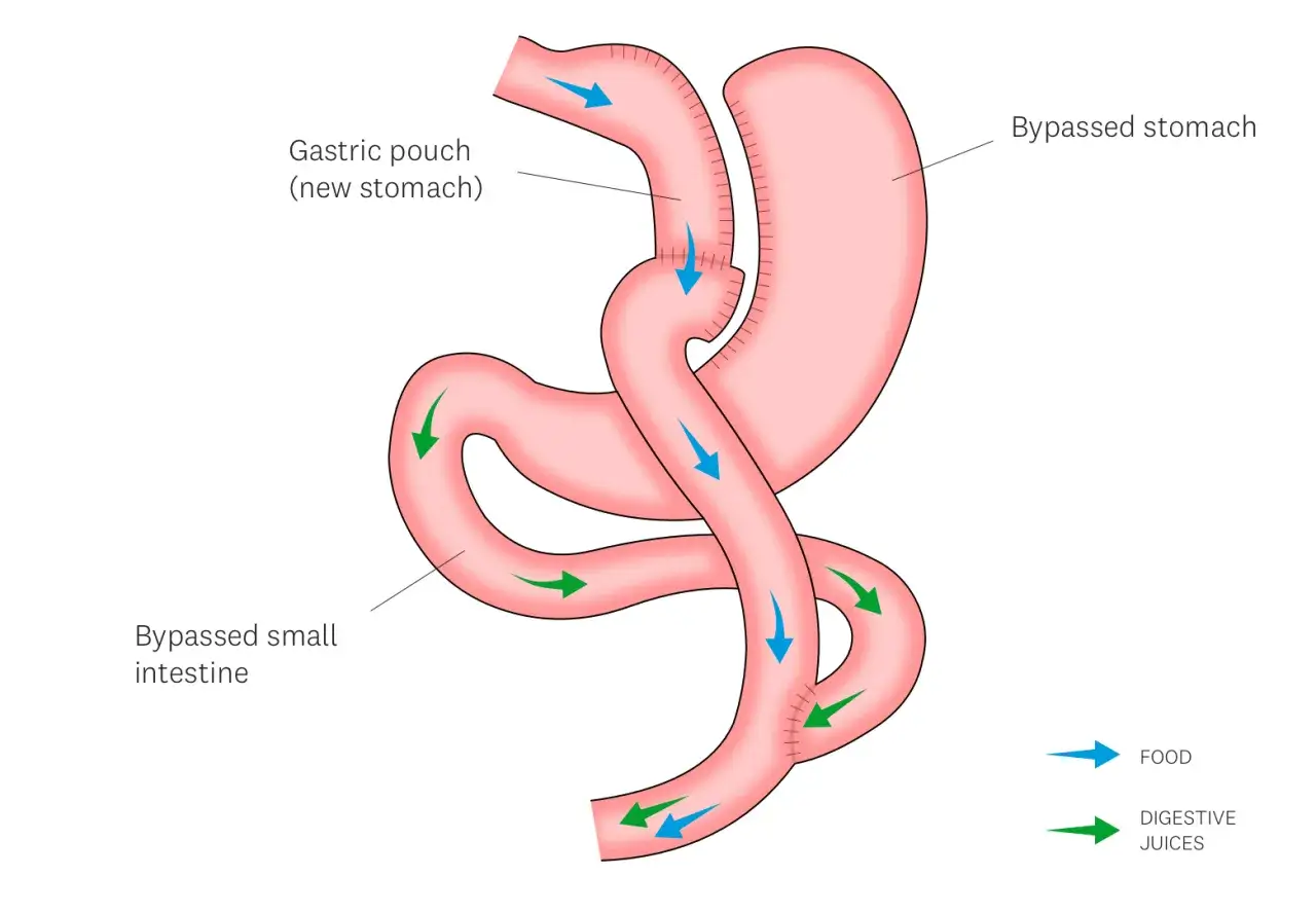 Schema eines Magen-Bypass: Nahrung flie&szlig;t in einen kleinen Magenbeutel, Verdauungss&auml;fte umgehen den gr&ouml;&szlig;ten Teil des Magens und D&uuml;nndarms.