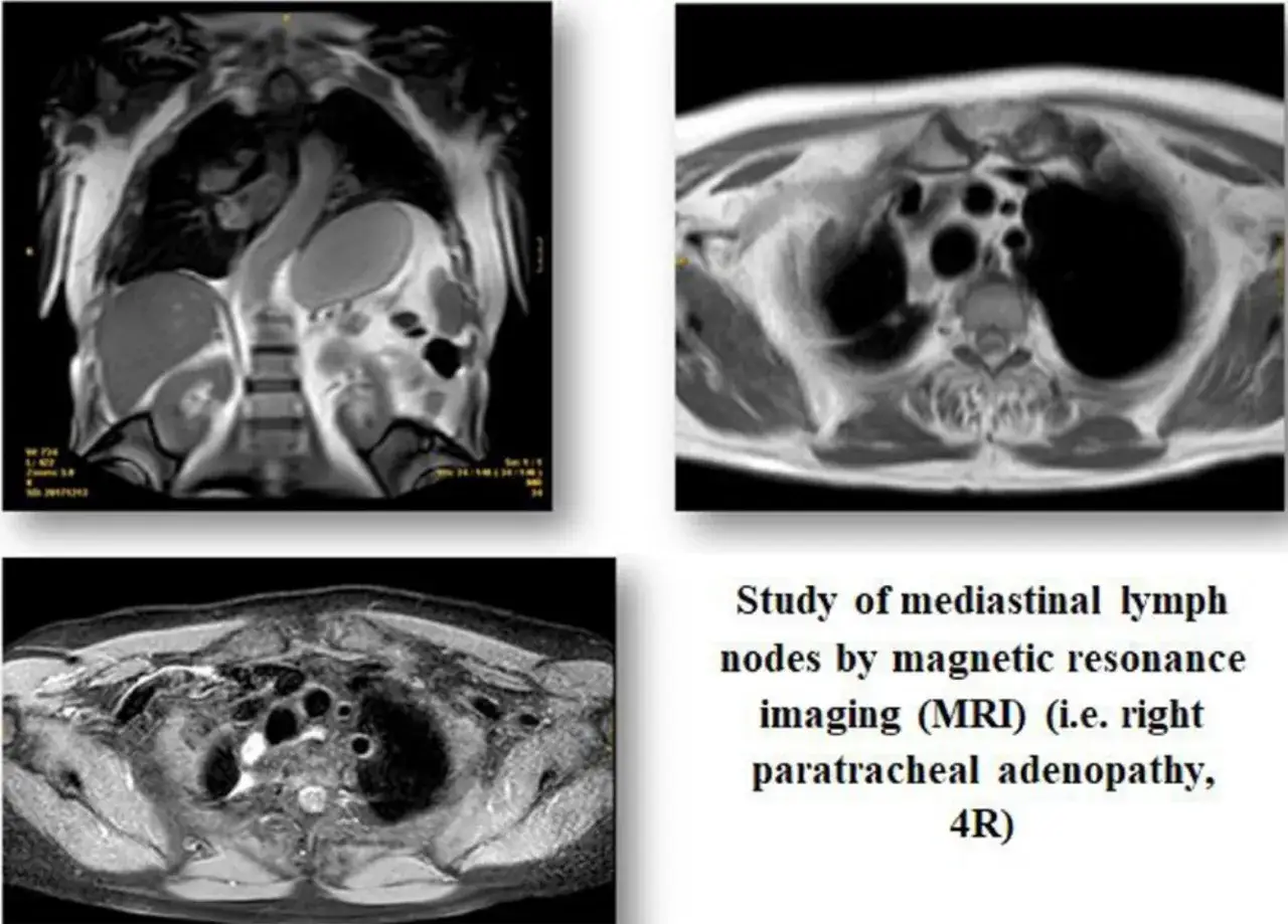 MRT-Aufnahmen des Brustkorbs zeigen den Lymphknotenbesatz im Mediastinum, insbesondere eine rechts paratracheale Adenopathie (4R).