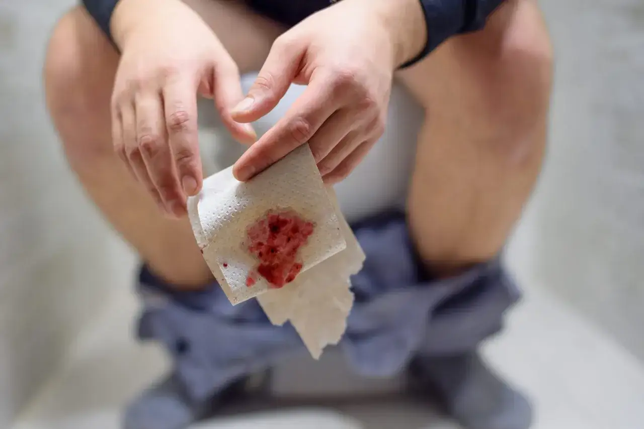 Krwawienie z odbytu na papierze toaletowym, jeden z objawów szczeliny odbytu.
