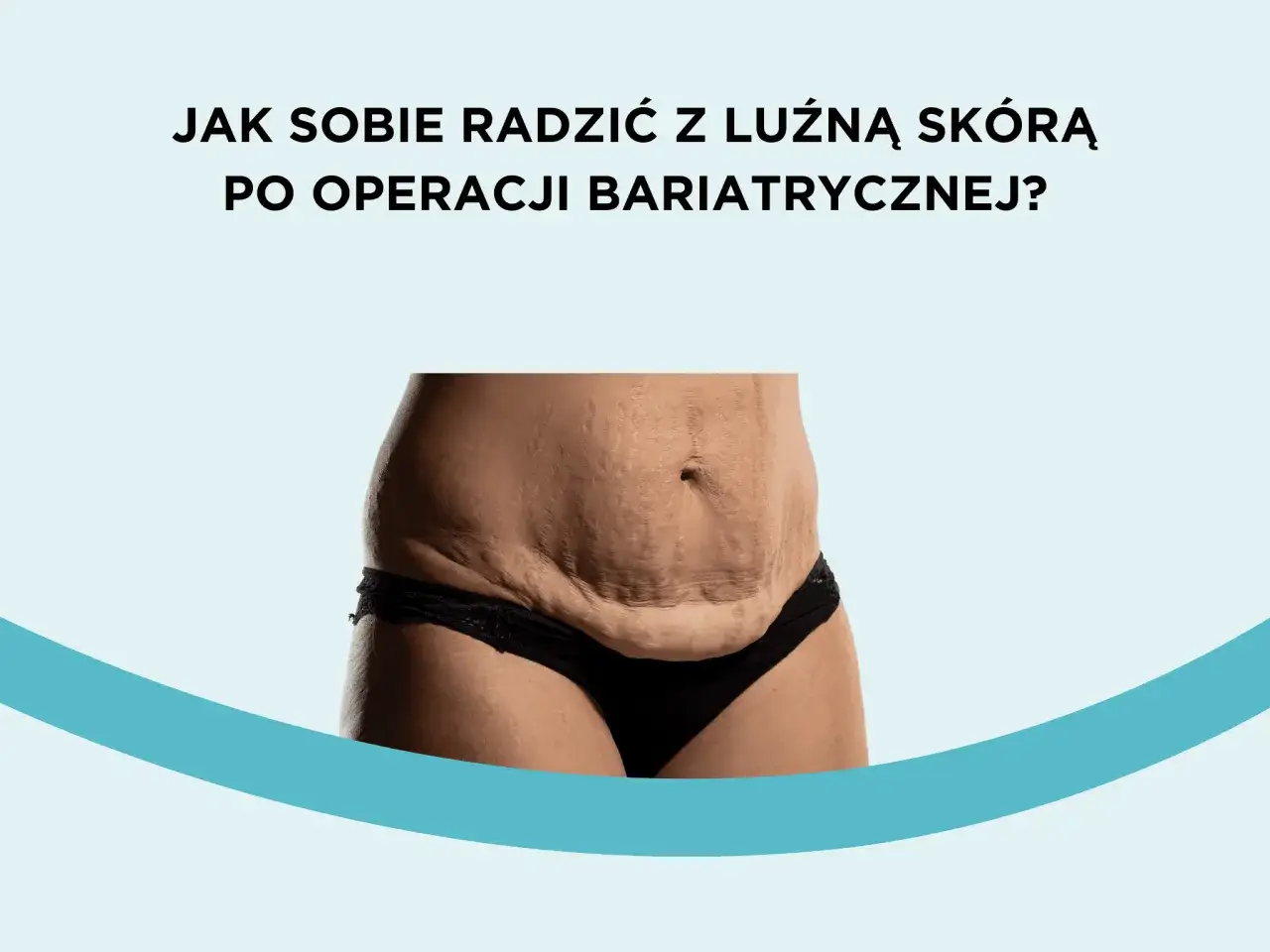 Luźna skóra po operacji zmniejszenia żołądka, widoczne rozstępy i fałdy na brzuchu.