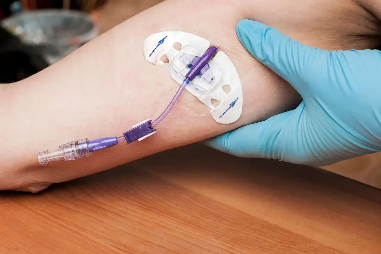 Braccio con catetere PICC per la chemioterapia. Guanto blu assiste la medicazione.