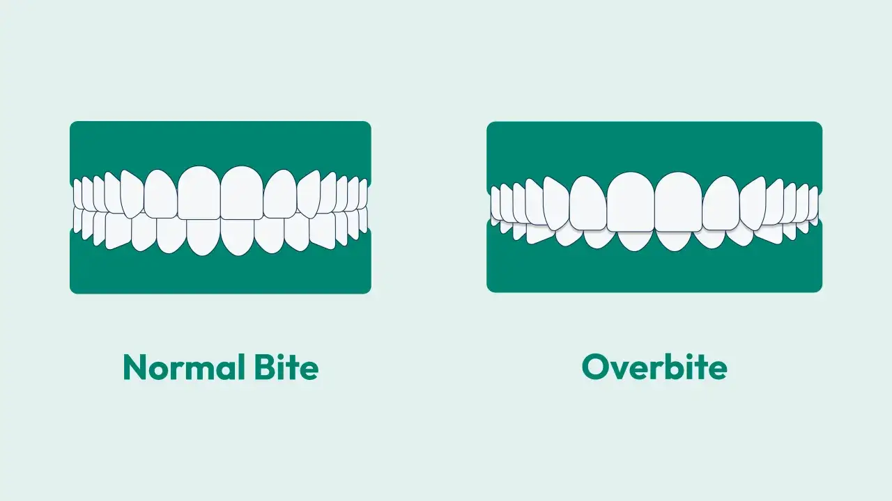 Comparación de mordida normal y sobremordida. La sobremordida es cuando los dientes superiores cubren excesivamente los inferiores.