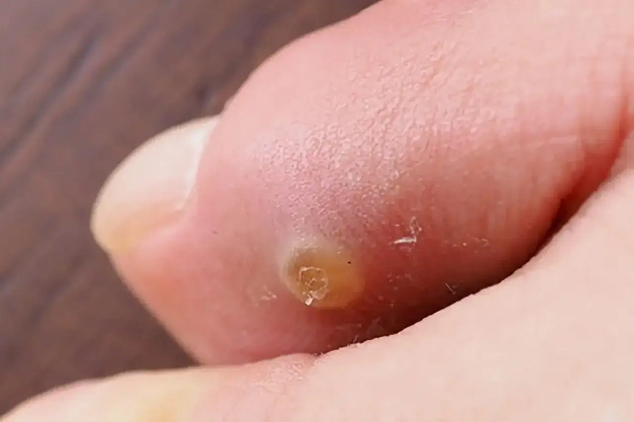 Gros plan sur un orteil présentant un cors au pied infecté, avec une peau rouge et irritée autour de la lésion.