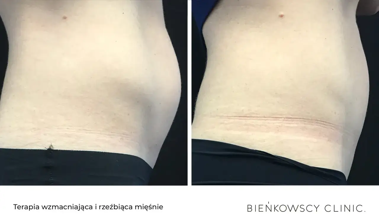 Przed i po zabiegu elektrostymulacji mięśni brzucha. Widoczna poprawa napięcia skóry i zarys mięśni.