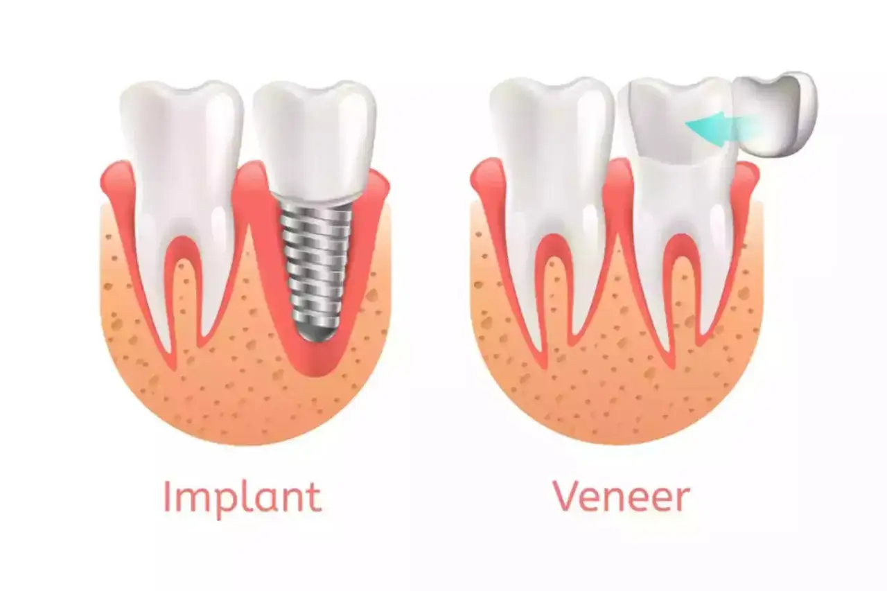 Immagine comparativa: un dente con impianto e un dente con faccetta in porcellana.