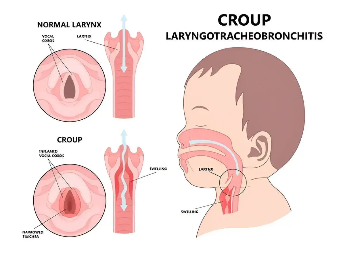 Illustrazione della laringite nei bambini (croup). Mostra la laringe normale e quella infiammata, con gonfiore e restringimento della trachea.