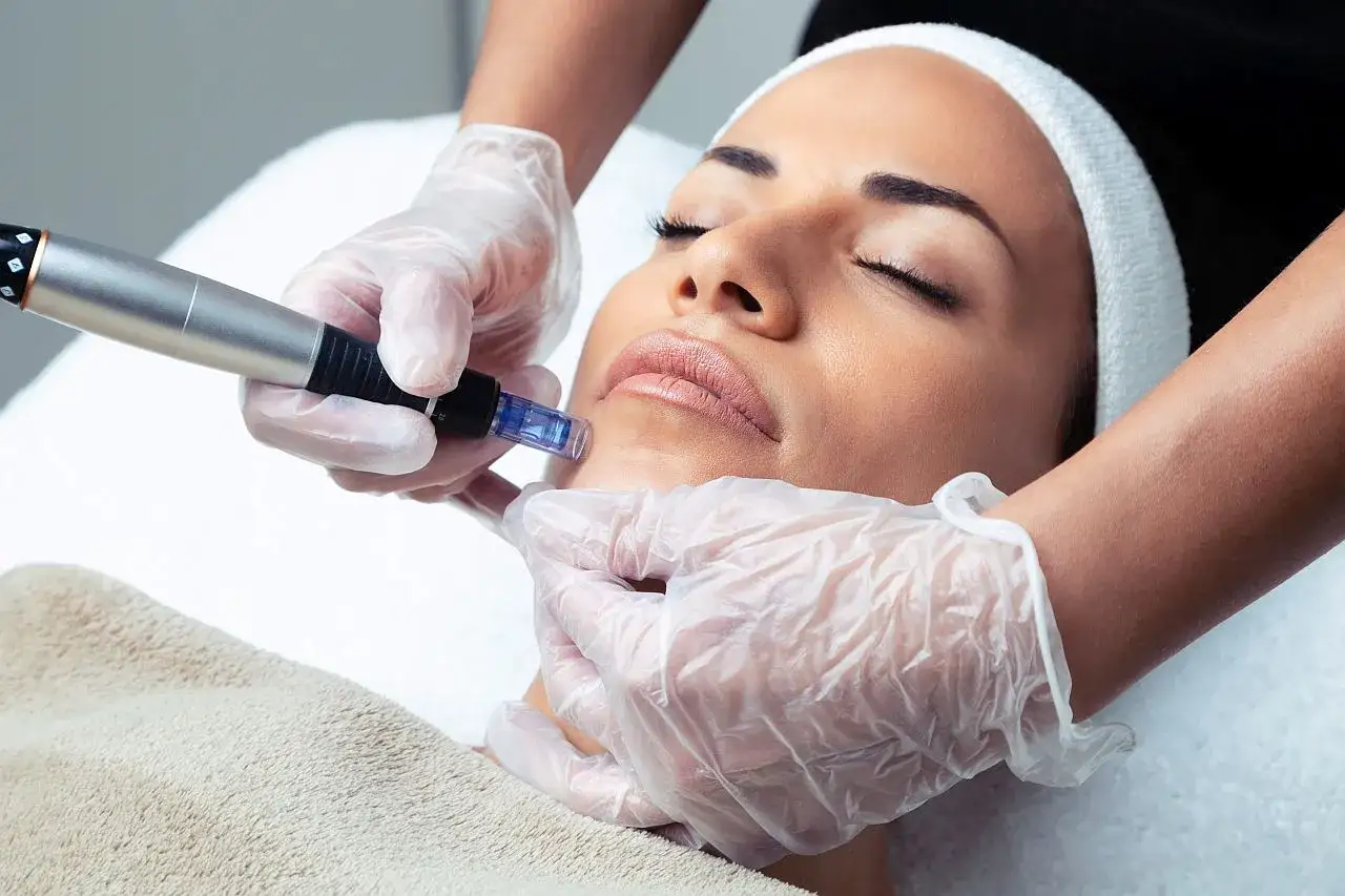 Zabieg mezoterapii mikroigłowej na twarz w klinice dermatologicznej.