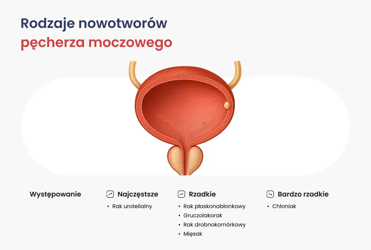 Ilustracja przedstawia pęcherz moczowy z widocznym guzem. Opisuje rodzaje nowotwor&oacute;w pęcherza moczowego, w tym raka urotelialnego, kt&oacute;ry jest najczęstszy.